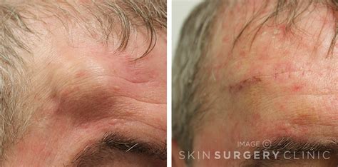 Sebaceous Cyst Face Removal