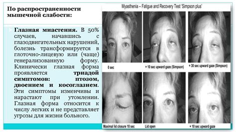 Миастения. Этиология. Патогенез - презентация онлайн