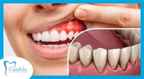 Why prevent gum inflammation during orthodontic treatment?