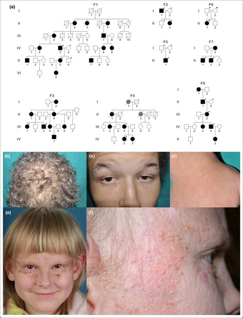 Bazex Dupre Christol Syndrome