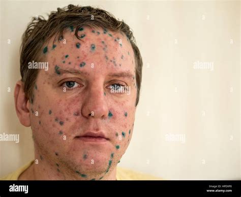 Varicella zoster virus or Chickenpox bubble rash on child, baby or ...