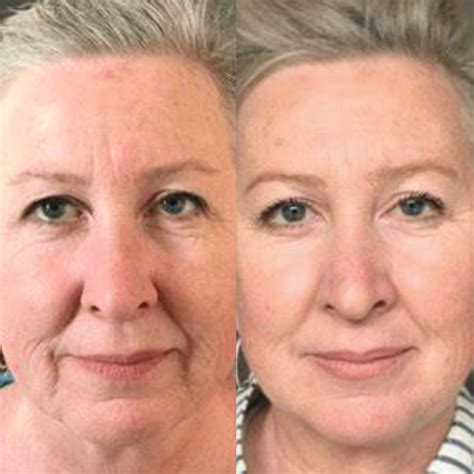 Microfocado Antes E Depois - Ultrassom Microfocado Antes e Depois | Palladium Estética