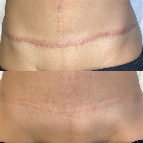 C Section Scar Before And After at Francine Rice blog