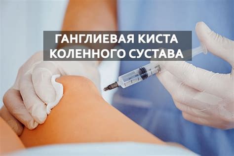 Ганглиевая киста коленного сустава: симптомы, диагностика и лечение