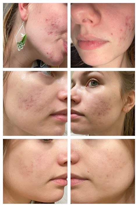 [B&A] Post cystic hormonal acne scarring microneedling treatment : r ...