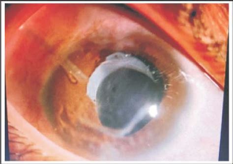 Ahmed Glaucoma Valve in Patient No. 3. | Download Scientific Diagram