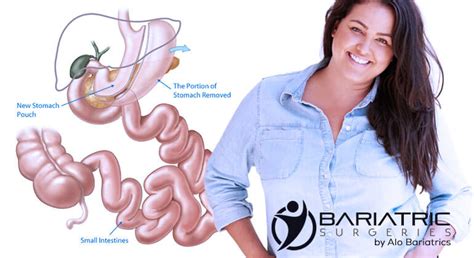 Mexico Gastric Sleeve – Bariatric Medical Solutions