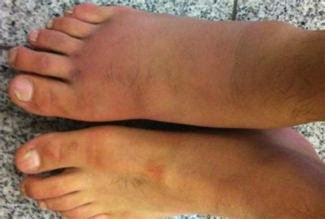 MMA Fighter Fractures Foot during Fight