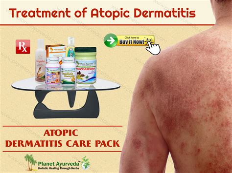 Treatment of Atopic Dermatitis with Natural Herbal Remedies