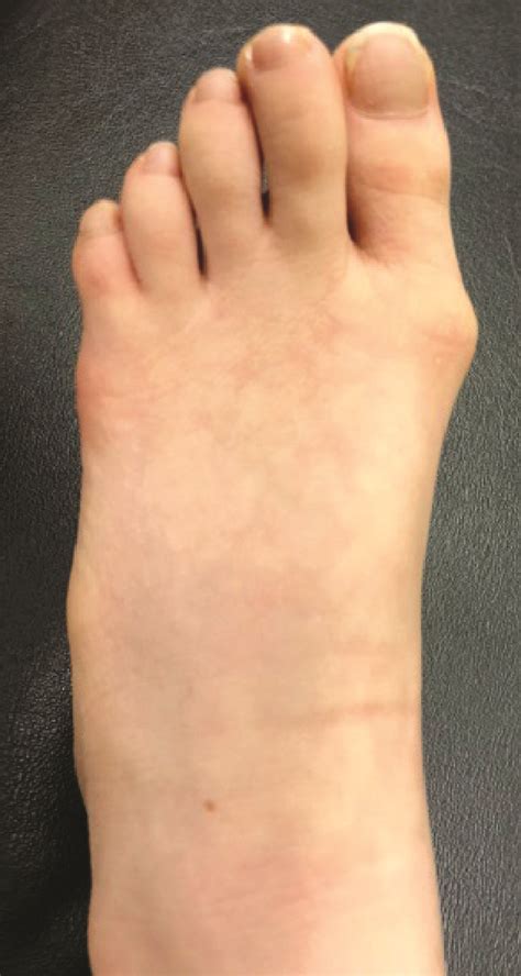 Pertinent Principles In Treating Juvenile Hallux Valgus