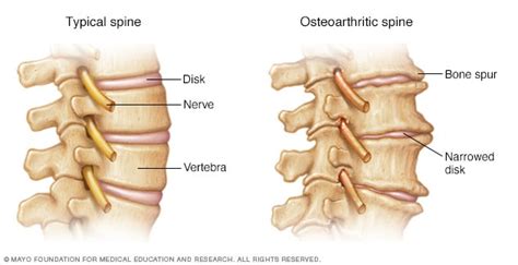 Bone spurs - Symptoms and causes - Mayo Clinic