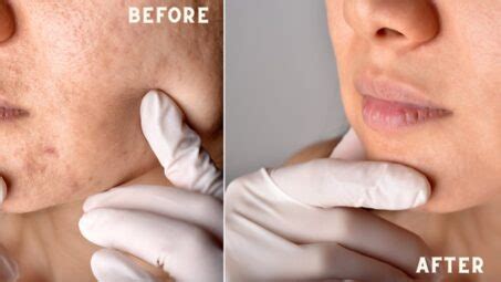 Which Is the Best Chemical Peel for Acne Scars?