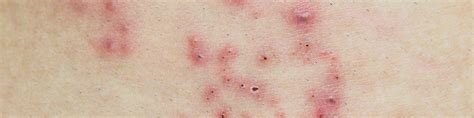 Hiv Rash On Lips | Lipstutorial.org
