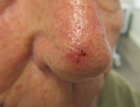 basal cell carcinoma pictures visual bcc examples   tehrani