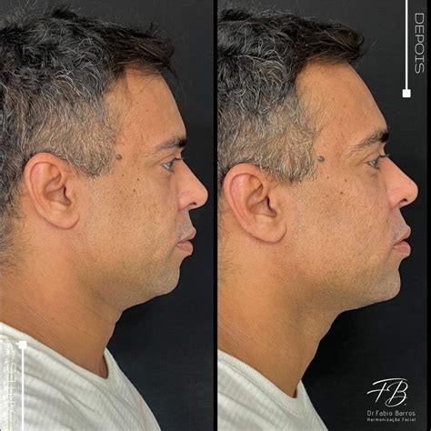 Preenchimento de Mandíbula | Harmonização Facial | Dr. Fabio Barros ...