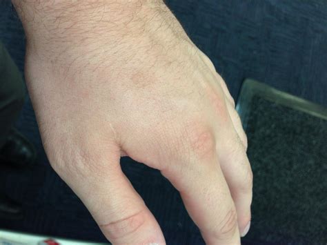 How to cure warts (with photos) : r/howto