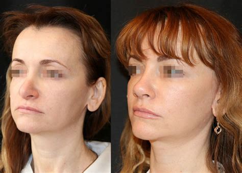 Nasal septum plastic surgery (septoplasty) in Kiev - cost and responses ...