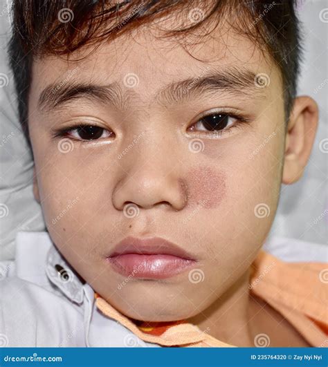 Tinea Faciei or Fungal Infection on Face of Asian Two Years Old Child