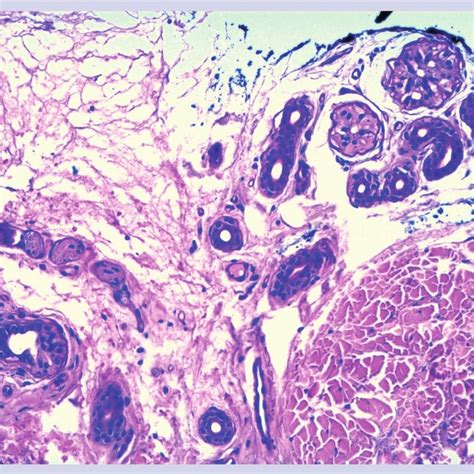 Histopathology of eosinophilic annular erythema. (A) Dense perivascular ...