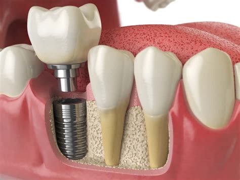 permanent tooth replacement  dental implants