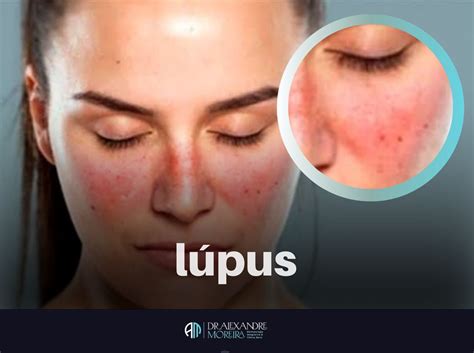 O Que Significa Lúpus - Tudo o que Você Precisa Saber sobre Lúpus - Dr.Alexandre Moreira ...