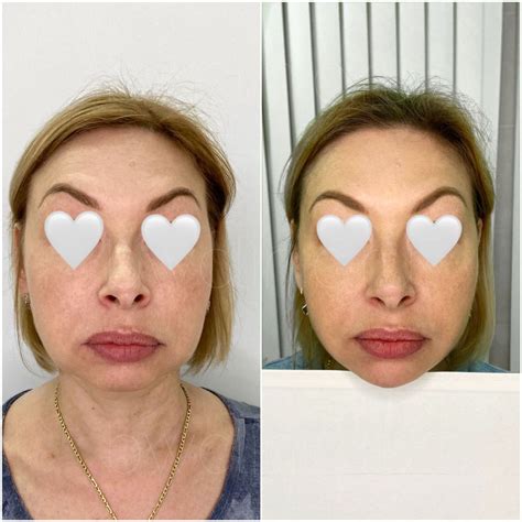 Процедуры инъекции липолитиков от 2490 руб/мл - BeautyWay Clinic 8 (499 ...