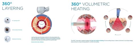 Body Contouring with Exilis Ultra 360 | BeautySmart Spa