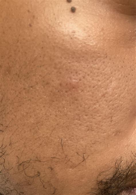 Intense itching when waking up in the morning sometimes accompanied by