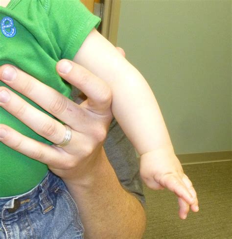 Congenital Clasped Thumb | Congenital Hand and Arm Differences