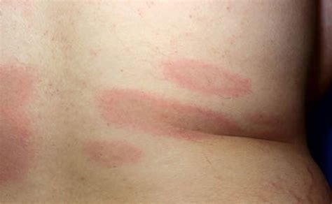 Lyme Disease - Rash, Causes, Symptoms, Diagnosis and Treatment
