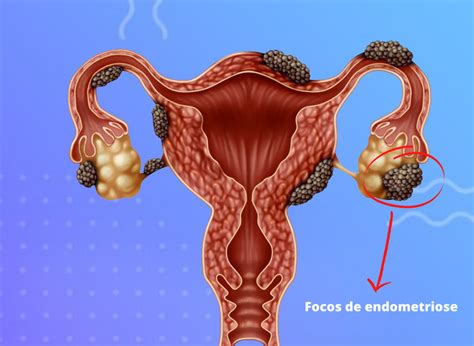 O Q E Endometriose E Seus Sintomas - Endometriose: o que é, sintomas, tipos e tratamento
