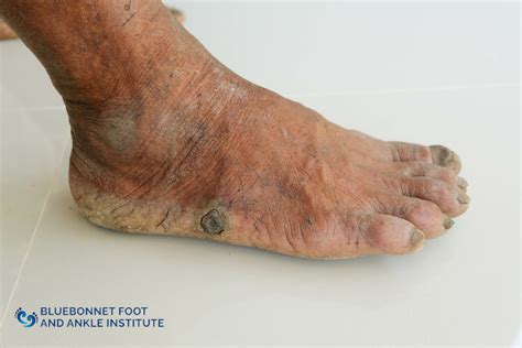 Diabetic Foot Syndrome - Bluebonnet Foot and Ankle Institute