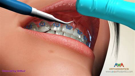 Laser Frenectomy