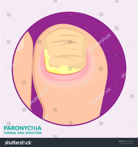 13 Herpetic Whitlow Images, Stock Photos & Vectors | Shutterstock