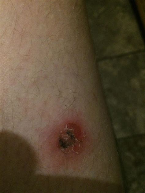 Spider bite? Pimple? – Acne – Acne.org Forum