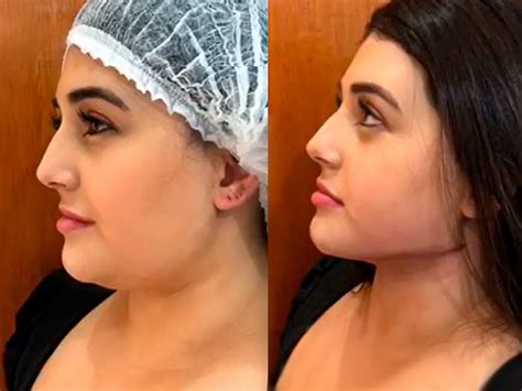Como É Feita A Lipo De Papada - Lipoaspiração de Papada: O que é, Valor, Procedimento
