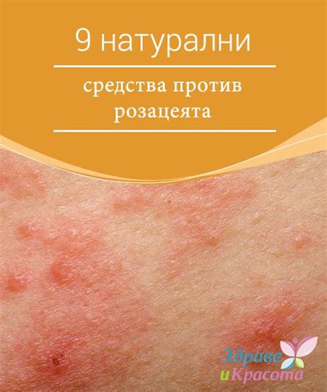 9 натурални средства против розацеята - Здраве и Красота | Food ...