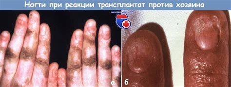 Причины появления борозд и отсутствия блеска ногтей