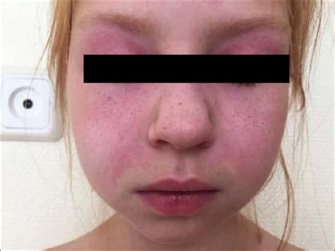 Girl, 9 years old, with dermatomyositis. Red-purple erythematous rashes ...