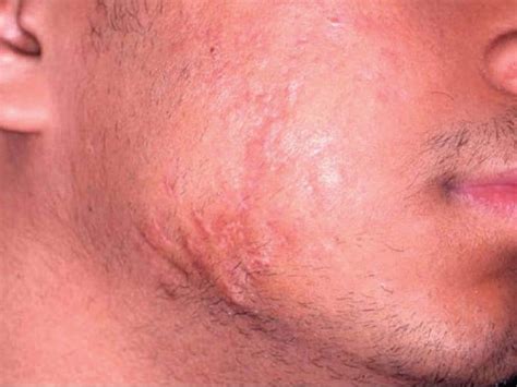Acne Scar Removal Treatments - Cambridge Therapeutics