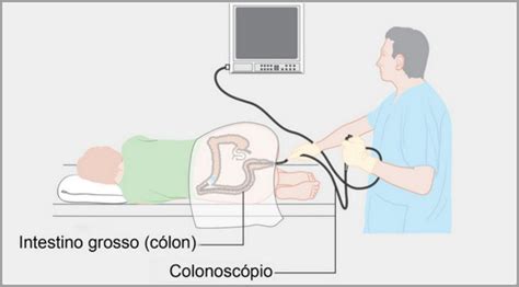 Como Fazer Exame Colonoscopia - Colonoscopia - Dr Ricardo Veloso Gastrenterologia Clínica e Endoscopia ...