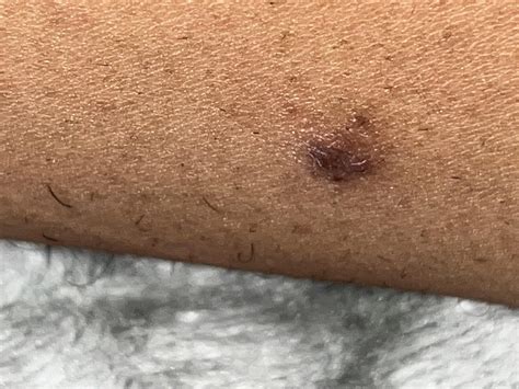 should i be worried about this bump on my inner thigh : r