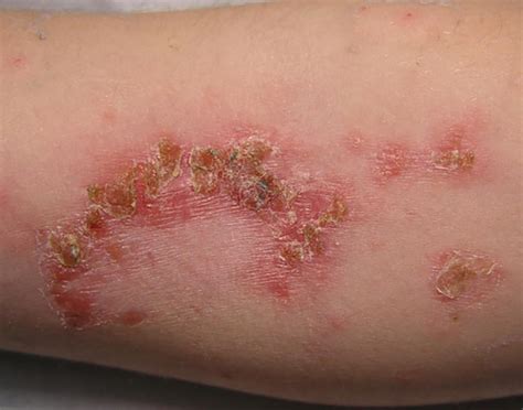 scab  elbow