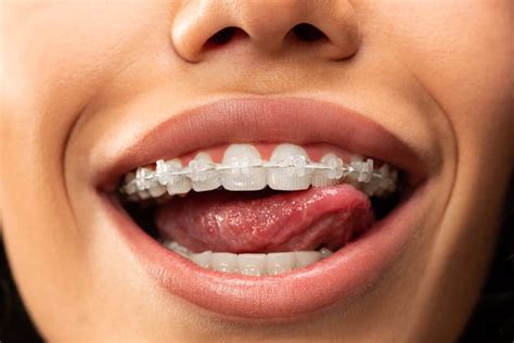 Beautiful Young Woman with Teeth Braces Stock Photo - Image of ...