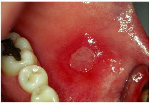 7 PROBLEM IN ORAL MUCOSA - OralProblem