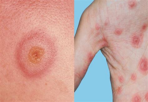 erythema multiforme hseie