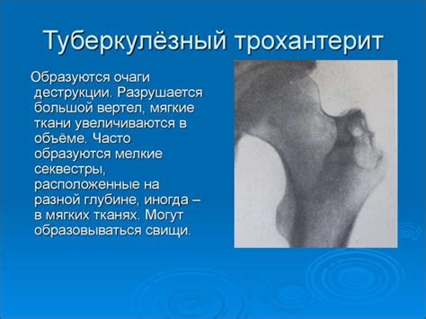 Трохантерит тазобедренного сустава: виды, симптомы, лечение и прогноз