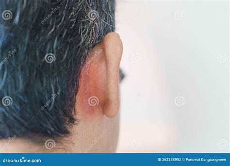 man  ear problems due  seborrheic dermatitis psoriasis