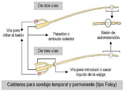 Sonda Foley: Tipologías, características y métodos de realización.