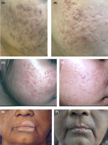 “Chemical Peel Recipe”—An easy and quick method of peel preparation in ...